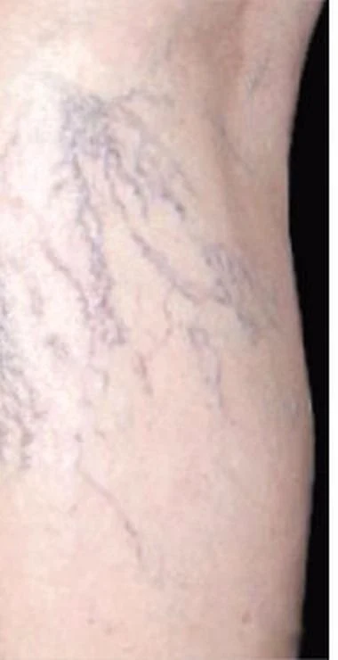 Before thread vein removal treatment